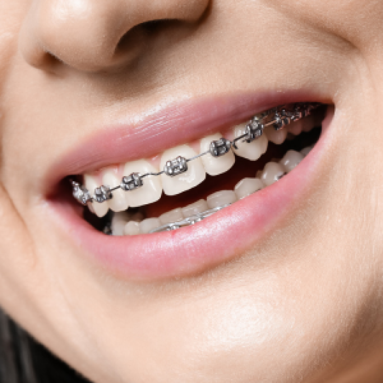 Metal braces Metal braces